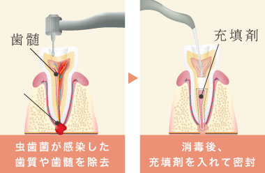 虫歯菌が感染した歯質や歯髄を除去 消毒後、充填剤を入れて密封