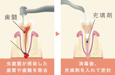 虫歯菌が感染した歯質や歯髄を除去 消毒後、充填剤を入れて密封