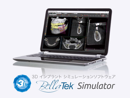 3D インプラント シミュレーションソフトウェア