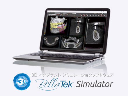 3D インプラント シミュレーションソフトウェア
